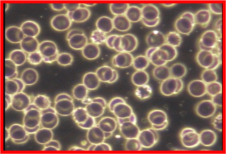 Blood cells before Auum Oil_1
