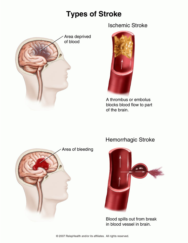 stroke and omega 3