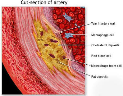 heart artery with cholesterol