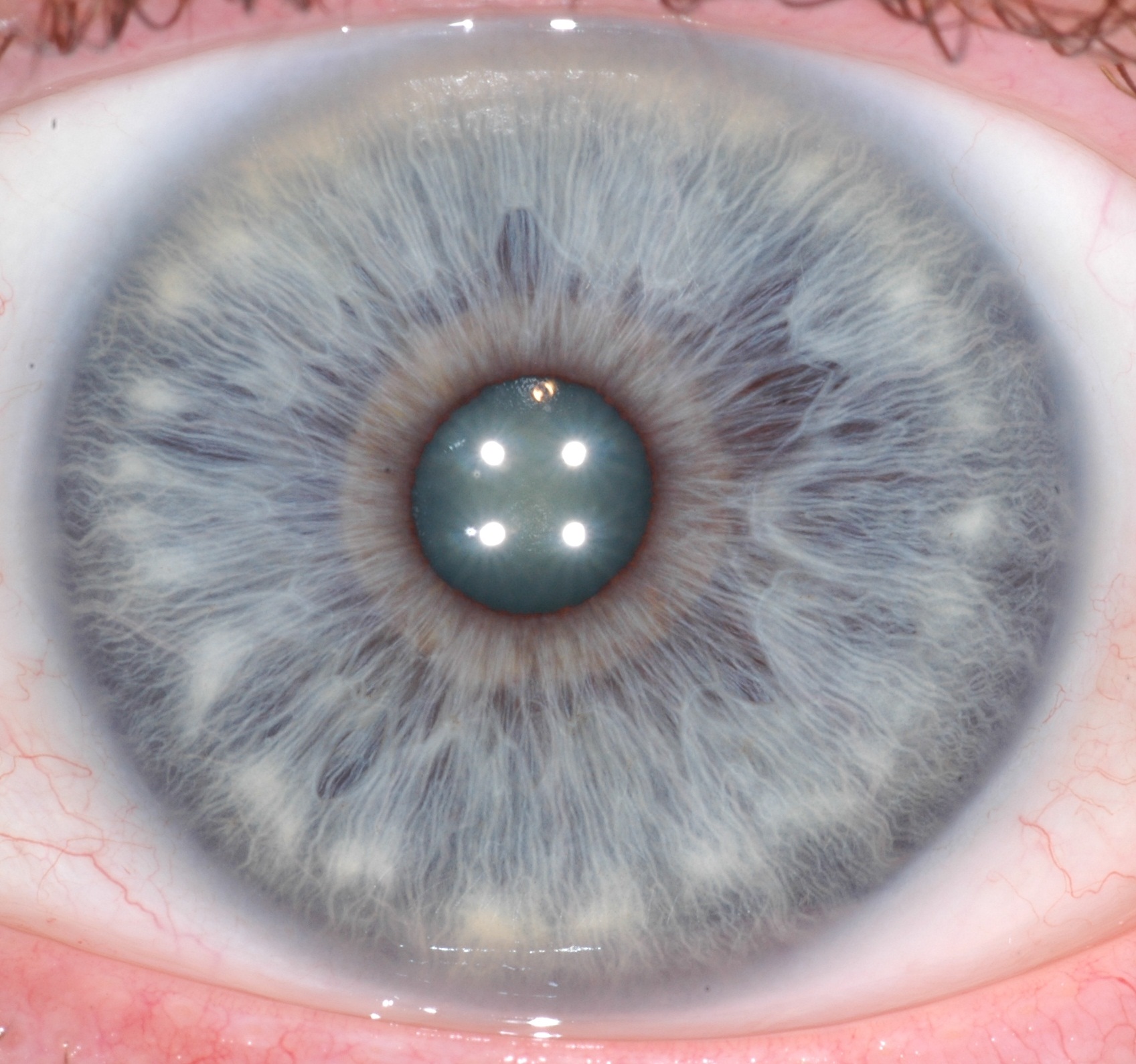 Iridology-Low-Stomach-Acid